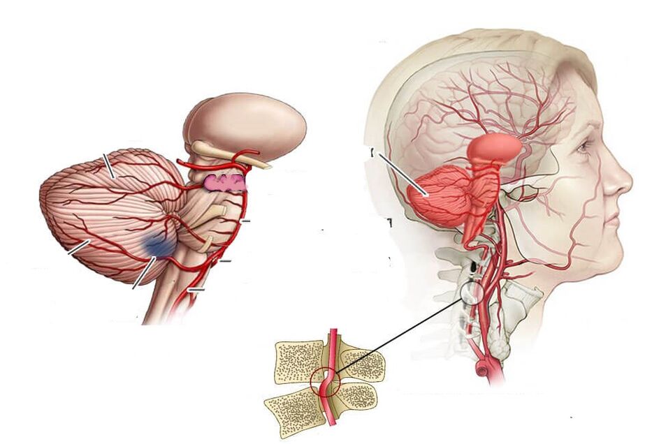 سیریبلر اسکیمیا